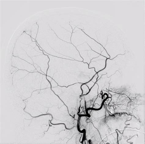 The Art Of Cerebral Angiography