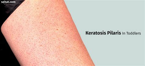 Keratosis Pilaris In Toddlers Symptoms Causes And Treatment
