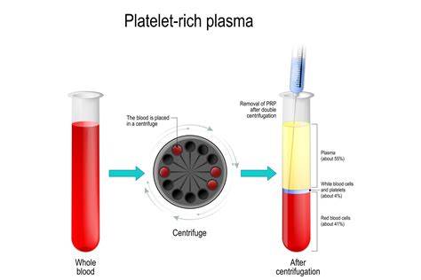 Prp Injections Lexington Ky Plasma Rich Platelet Anti Aging Institute