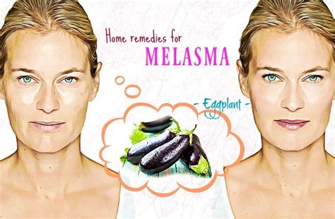 25 Natural Home Remedies For Melasma Treatment