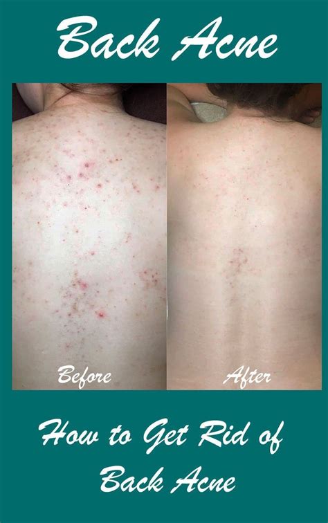 How I Treated My Back Acne How To Get Rid Of Acne Back Acne Remedies