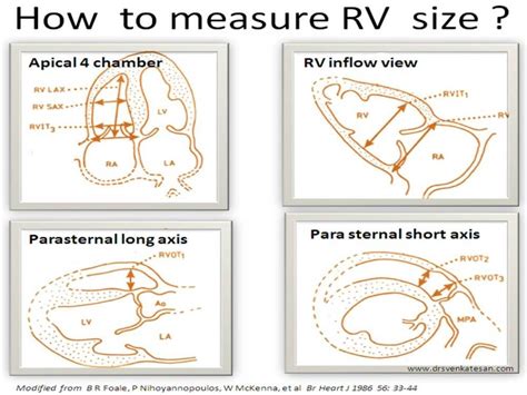 What Is The Normal Rv Size How To Measure It By Echocardiography
