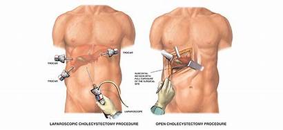 Surgery Laparoscopic Open Gallbladder Recovery Between Cholecystectomy