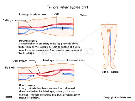 Femoral Artery Bypass Graft Illustrations