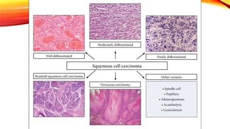 Squamous Cell Carcinoma Oral Cancer Ppt