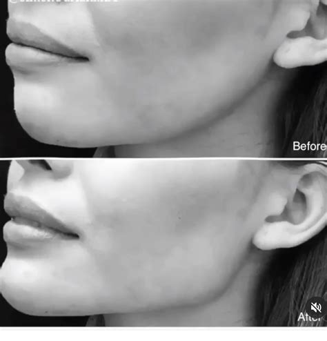 A Perfect Chiseled Jawline Chiseled Jawline Face Plastic Surgery