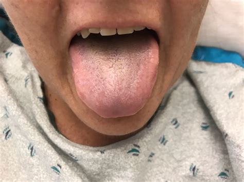 White Hairy Tongue Causes White Or Black Hairy Tongue