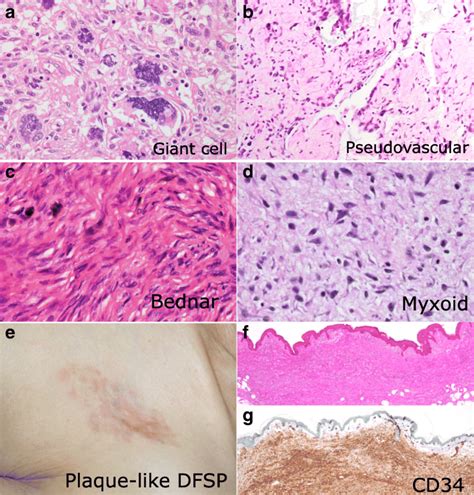 Histological Appearance Of Variants Of Dermatifibrosarcoma Protuberans