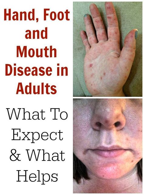 Hand Foot And Mouth Disease In Adults What To Expect Others Hand