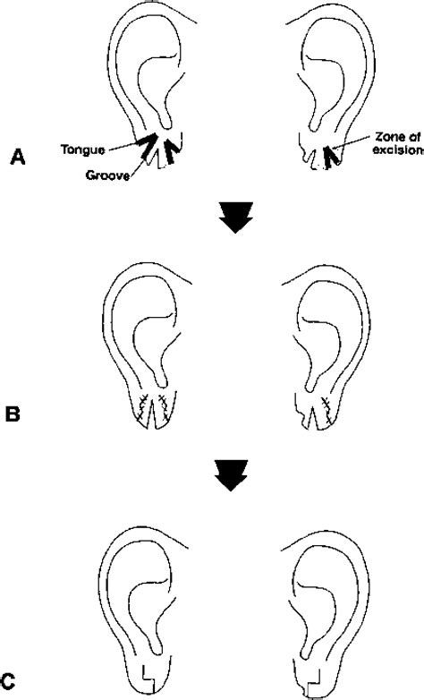 Figure 2 From A Method Of Treatment Of Multiple Unilateral Earlobe