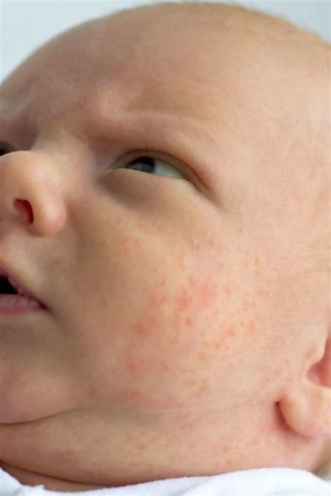 What Does Newborn Acne Look Like