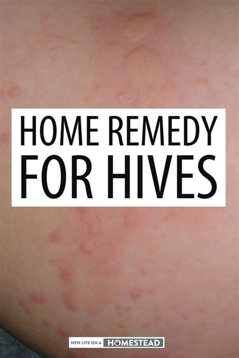 Natural Home Remedy For Hives • New Life On A Homestead