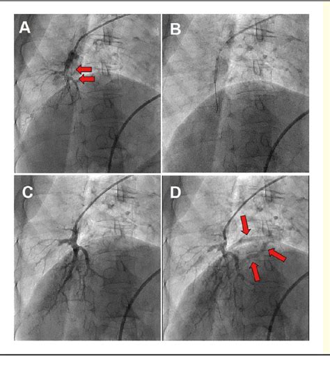 Representative Angiography In Balloon Pulmonary Angioplasty Bpa In A