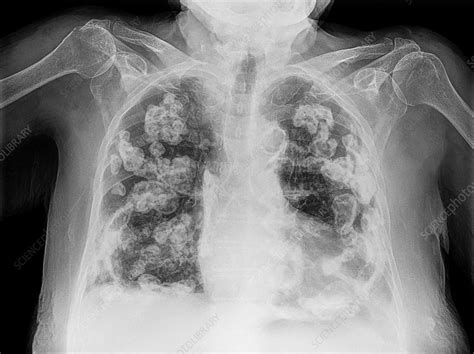 Bilateral Pleural Calcification X Ray Stock Image C0382424