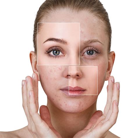 Acne Treatment Improve Your Skin Aesthetics Oswestry