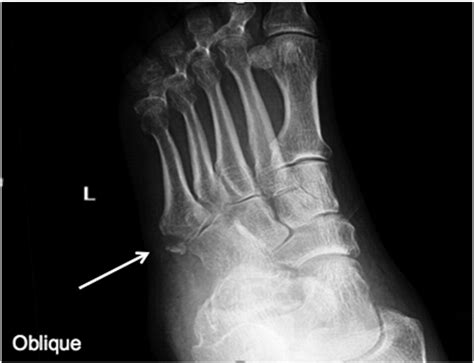 References In Avulsion Fractures In The Foot Telltale Radiographic