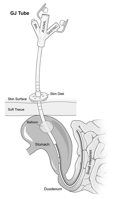 Peg Tube Pej Jejunostomy Percutaneous Endoscopic Gastrostomy Placement