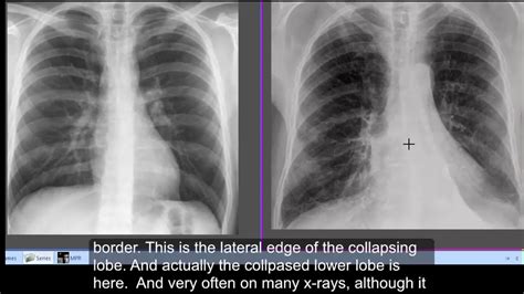 Chest X Ray Left Lower Lobe Collapse Ct Chest Lower Lobe Collapse