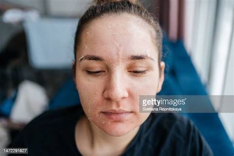 Face Skin Peel Photos And Premium High Res Pictures Getty Images