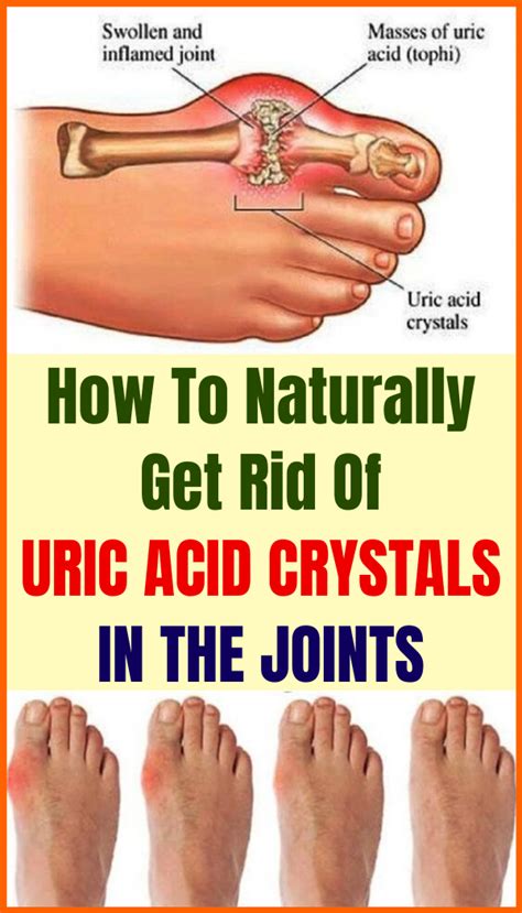 How To Naturally Get Rid Of Uric Acid Crystals In The Joints Wellness