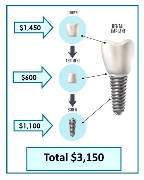 Dental Implant Faqs In Cincinnati Oh Total Dentistry