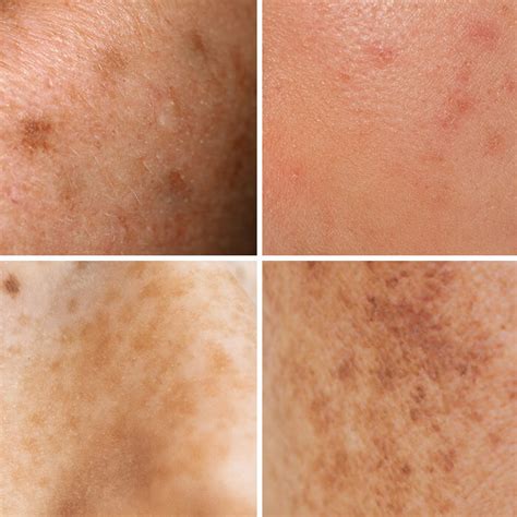 How Hyperpigmentation Happens — And What You Can Do About It Slmd