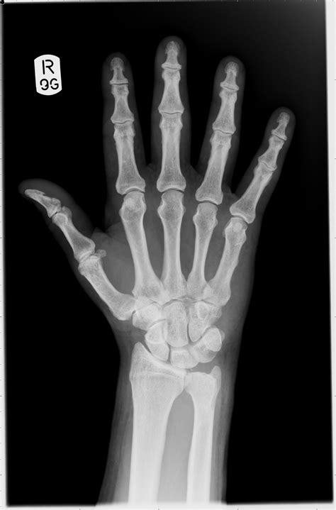 Your x ray right hand stock images are ready. Hand x-ray. Causes, symptoms, treatment Hand x-ray