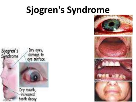 Sjögrens Syndrome Dry Syndrome Causes Symptoms And Treatment