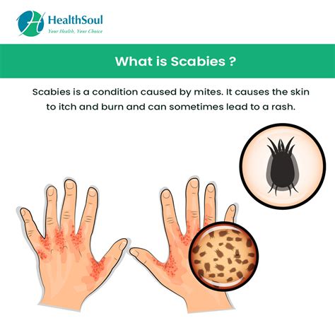 How To Identify Scabies Symptoms Treatment Diagnosis Vrogue Co