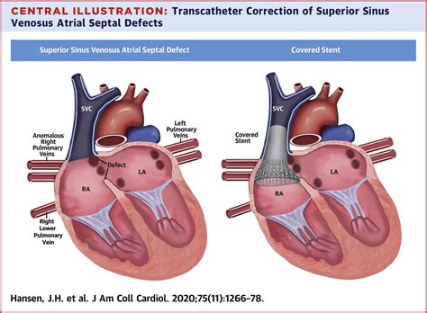 Transcatheter Correction of Superior Sinus Venosus Atrial Septal