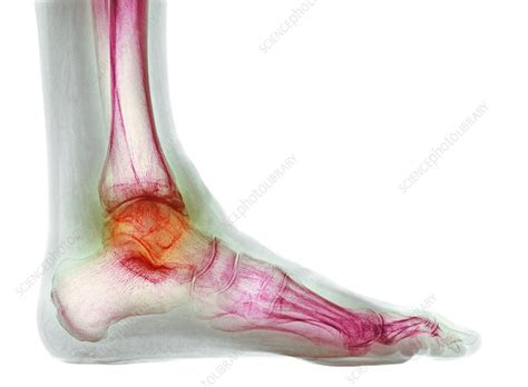 Osteoarthritis Of The Ankle X Ray Stock Image C0426425 Science