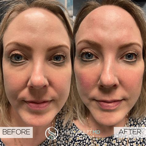 Facial Filler Before And After Gallery Omni Sculpt Md