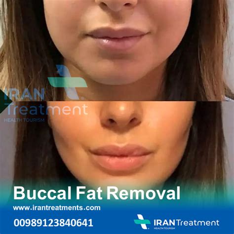 buccal fat removal in iran cheek reduction surgery irantreatments plastic surgery in iran