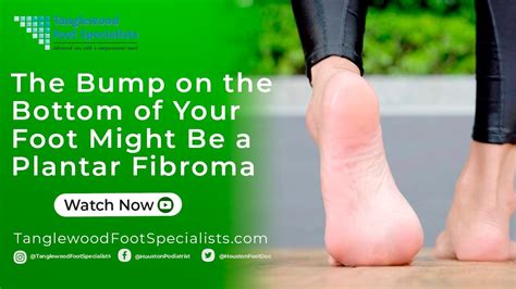 The Bump On The Bottom Of Your Foot Might Be A Plantar Fibroma Youtube
