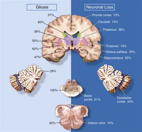 Encephalopathy Of Prematurity Neuropathology Neupsy Key