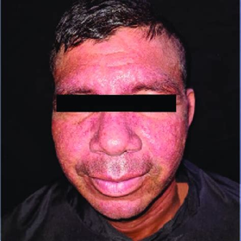 A Multiple Hyperkeratotic Papules And Plaques Over The Centrofacial
