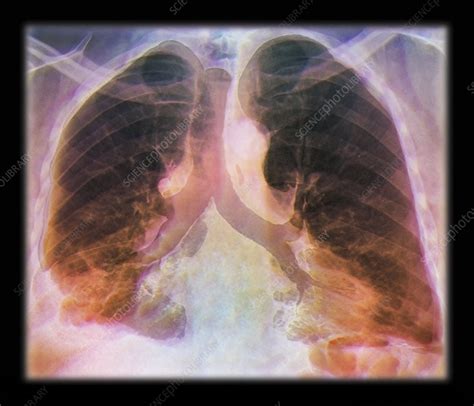 Kaposis Sarcoma Of The Lung Ct Scan Stock Image C0132192