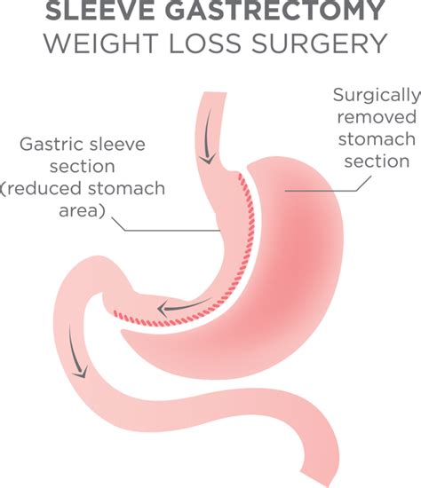 Gastric Sleeve Surgery Chan Soon Shiong Medical Center At Windber