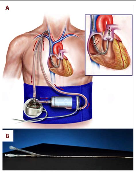 Figure 1 From Concurrent Left Ventricular Assist Device Lvad