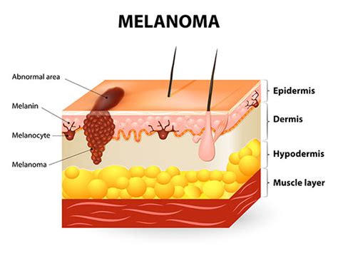 Types Of Skin Cancer Different Types And Treatments Columbia Skin