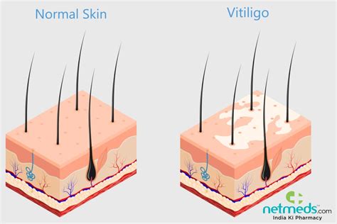 Vitiligo Causes Symptoms And Treatment
