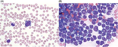 Burkitt Lymphoma With Tumor Cells In The Peripheral Blood A And