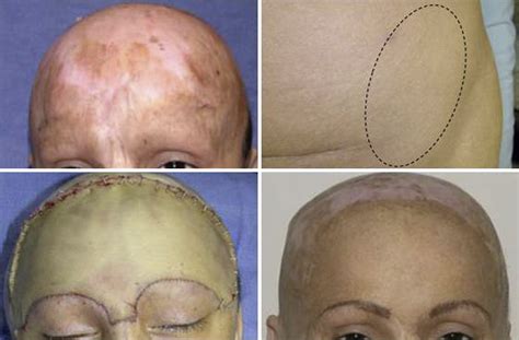 Reconstruction Of Scalp And Forehead Defects Clinics In Plastic Surgery