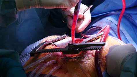 Coronary Artery Bypass Graft Surgery Close Up Full Hd Stock Footage