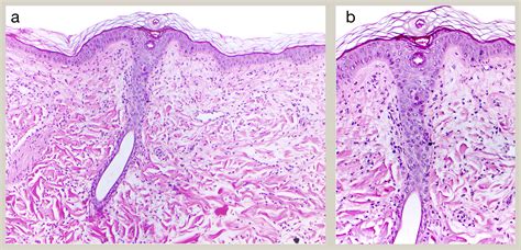 Non Infectious Neutrophilic And Pustular Dermatoses Diagnostic