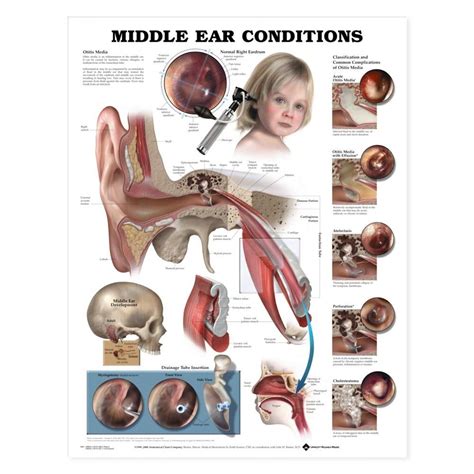 Middle Ear Conditions Poster Ear Disease Anatomical Chart Company