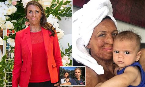 Turia Pitt Explains Some Of The Biggest Struggles Of Being A New Mum Daily Mail Online