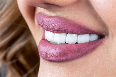 Improve Your Smile with Weston Spencer DDS' Porcelain Veneers - Weston