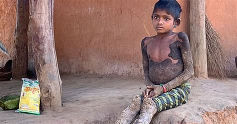 Year Old Girl S Rare Condition Turns Her Skin Into Stone Small Joys