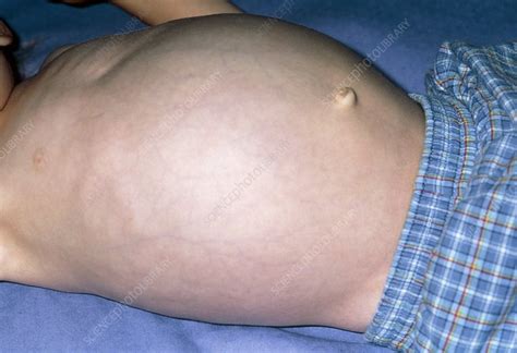 swollen abdomen due to hepatomegaly from cancer stock image m131 0335 science photo library